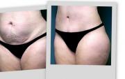 , Tummy Tuck Recovery Experiences