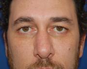 , Upper Eyelid Surgery