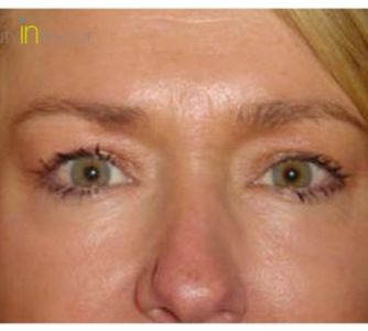 L. V. (Eye Lift Surgery Review)