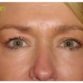 L. V. (Eye Lift Surgery Review)