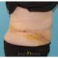 Pamela, UK (Tummy Tuck with Liposuction Review)