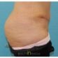 Shelley, UK (Tummy Tuck with Liposuction Review)