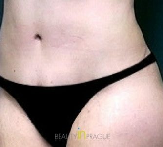 Joanne, UK (Mini Tummy Tuck Review)