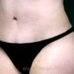 Joanne, UK (Mini Tummy Tuck Review)