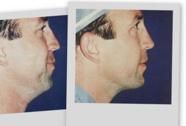 , Cosmetic Surgery a Growing Trend for Men