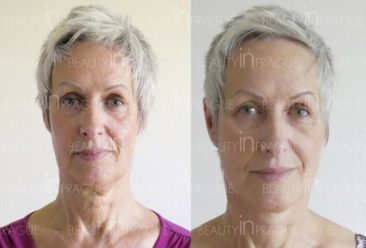 , My Facelift experience at Beauty in Prague