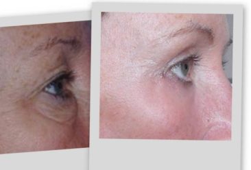 , Laser Transconjunctival Blepharoplasty