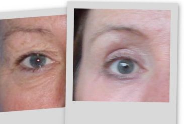 , Laser Transconjunctival Blepharoplasty