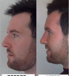 , Patient story Rhinoplasty &#8211; Nose Job surgery