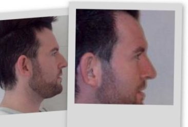 , Cosmetic Surgery a Growing Trend for Men
