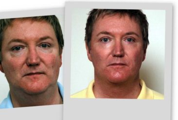 , Cosmetic Surgery a Growing Trend for Men