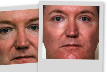 , Cosmetic Surgery a Growing Trend for Men