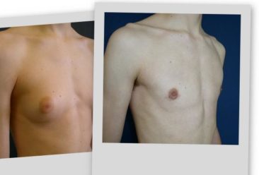 , Lower price for Medium Gynecomastia