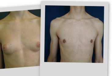 , Lower price for Medium Gynecomastia