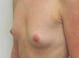 , Breast enlargement before and after photos