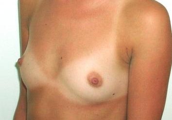 , Breast enlargement before and after photos