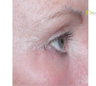 Carol, UK (Eyelid surgery Review)