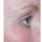 Carol, UK (Eyelid surgery Review)