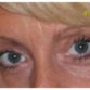 Sue, UK (Eyelid surgery Review)