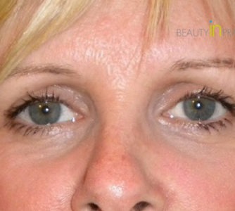 Kerry (Eyelid surgery Review)