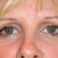 Kerry (Eyelid surgery Review)