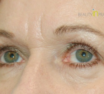 Mary, UK (Eyelid surgery Review)