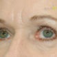 Mary, UK (Eyelid surgery Review)