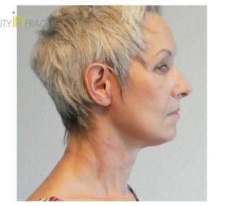 A. K. (Face Lift and Neck lift Review)