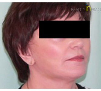 Dorothy, UK (Facelift, Arm Lift Review)