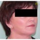 Dorothy, UK (Facelift, Arm Lift Review)