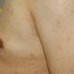 Richard, UK (Male Breast Reduction Review)