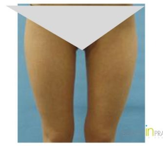 Michelle, UK (Liposuction Review)