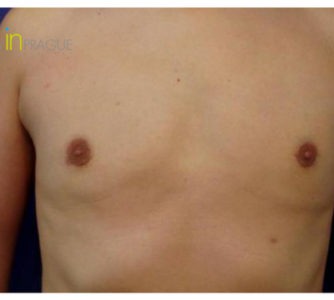 Robert, UK (Male Breast Reduction Review)