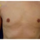 Robert, UK (Male Breast Reduction Review)