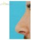 K. G. (Rhinoplasty Review)