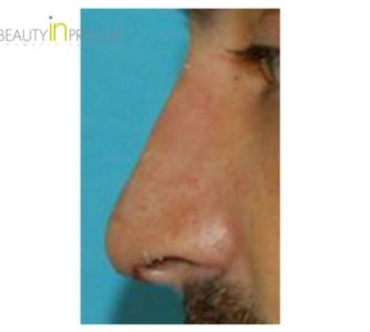 G. S. (Rhinoplasty Review)