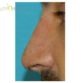 G. S. (Rhinoplasty Review)