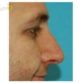 M. R. (Rhinoplasty Review)