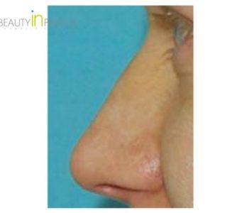 I. H. (Nose Tip Reshaping Review)