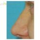 I. H. (Nose Tip Reshaping Review)