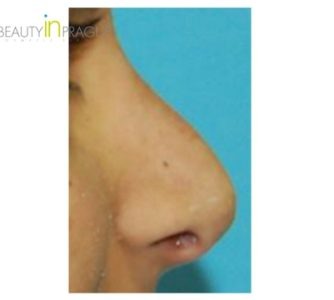 K. D. (Rhinoplasty Review)