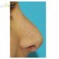 K. D. (Rhinoplasty Review)