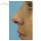 A. W. (Rhinoplasty)