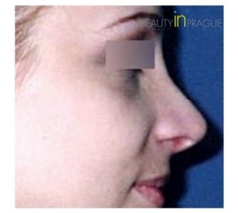 S. H. (Rhinoplasty Review)