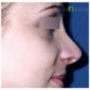 S. H. (Rhinoplasty Review)