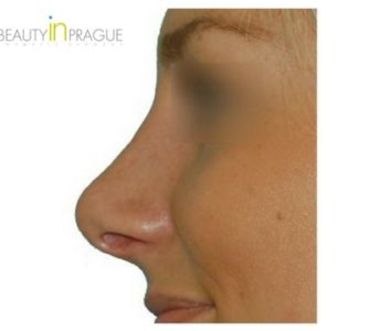 R. H. (Rhinoplasty Review)