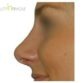 R. H. (Rhinoplasty Review)