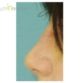 M. L. (Rhinoplasty Review)