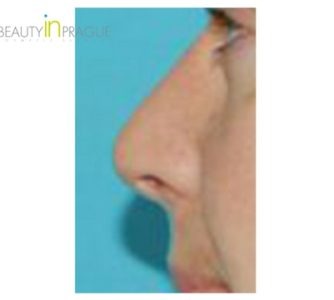 P. N. (Rhinoplasty Review)