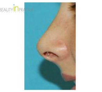 G. A. (Rhinoplasty Review)